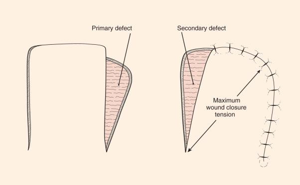 Fig. 2.5.9, Geometry of a transposition flap. As the degree of rotation is increased, the flap becomes shorter, necessitating that the flap extend beyond the defect.