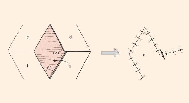 Fig. 2.5.10, Design of the Limberg transposition flap of a rhombic defect with 60- and 120-degree angles; four potential flaps exist for any defect; skin laxity and placement of final scar should be considered when deciding which configuration to use. Note the location of maximum tension (arrows) after primary closure.