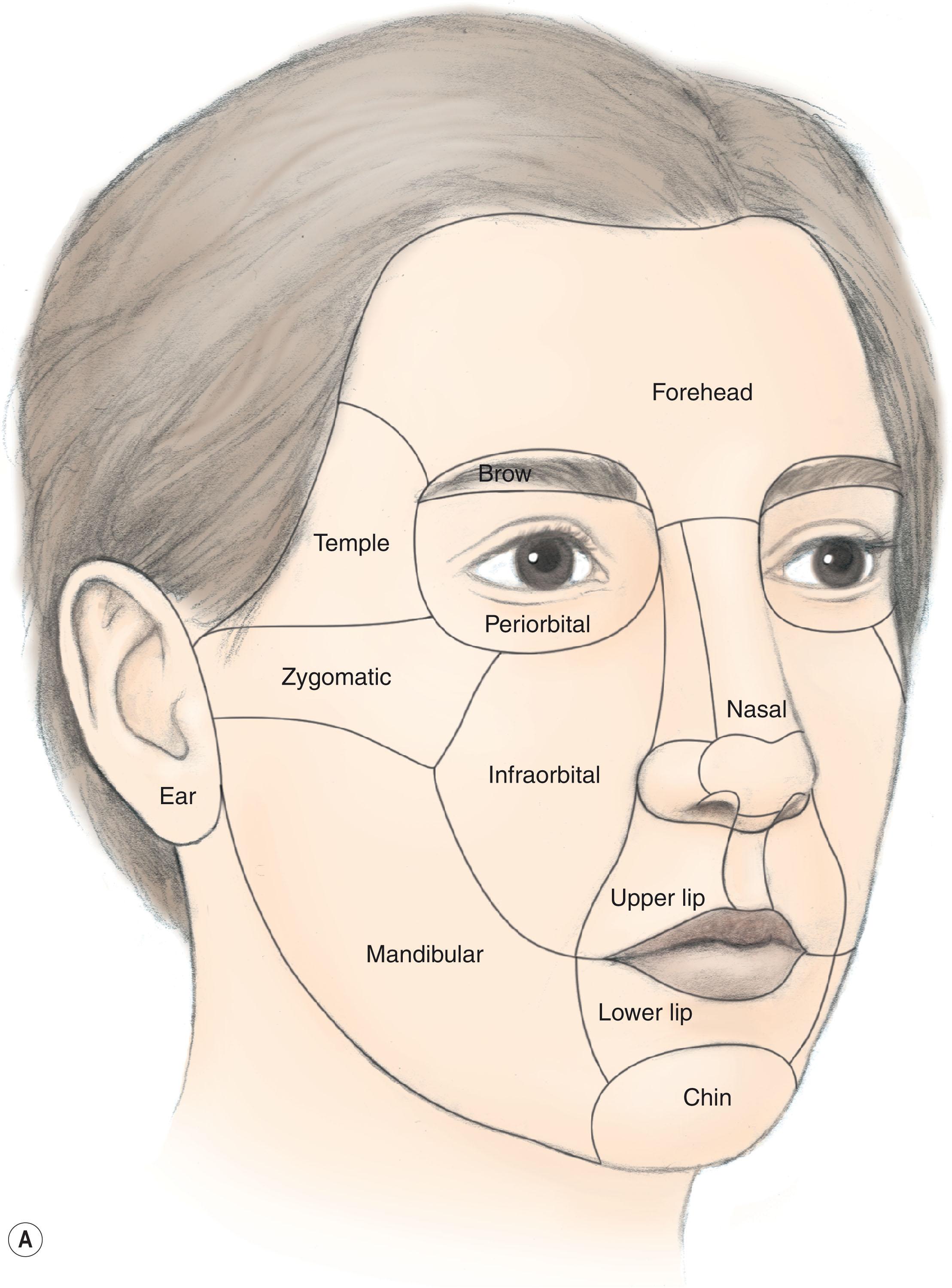 Figure 10.1, (A) Aesthetic subunits of the face – note that the borders of the various subunits are determined by naturally occurring peaks and valleys of the face. Figure 10.1, cont’d (B) Subunits of the nose – subunit borders are determined by either the bony skeleton, cartilaginous skeleton, or the fibrofatty tissue of nose. (C) Subunits of the lip – subunit borders are determined superiorly by the alar base anatomy and columella, laterally by the nasolabial fat pad and lip elevators, centrally by the decussation of the orbicularis oris, and inferiorly by the vermillion lip and its contours.