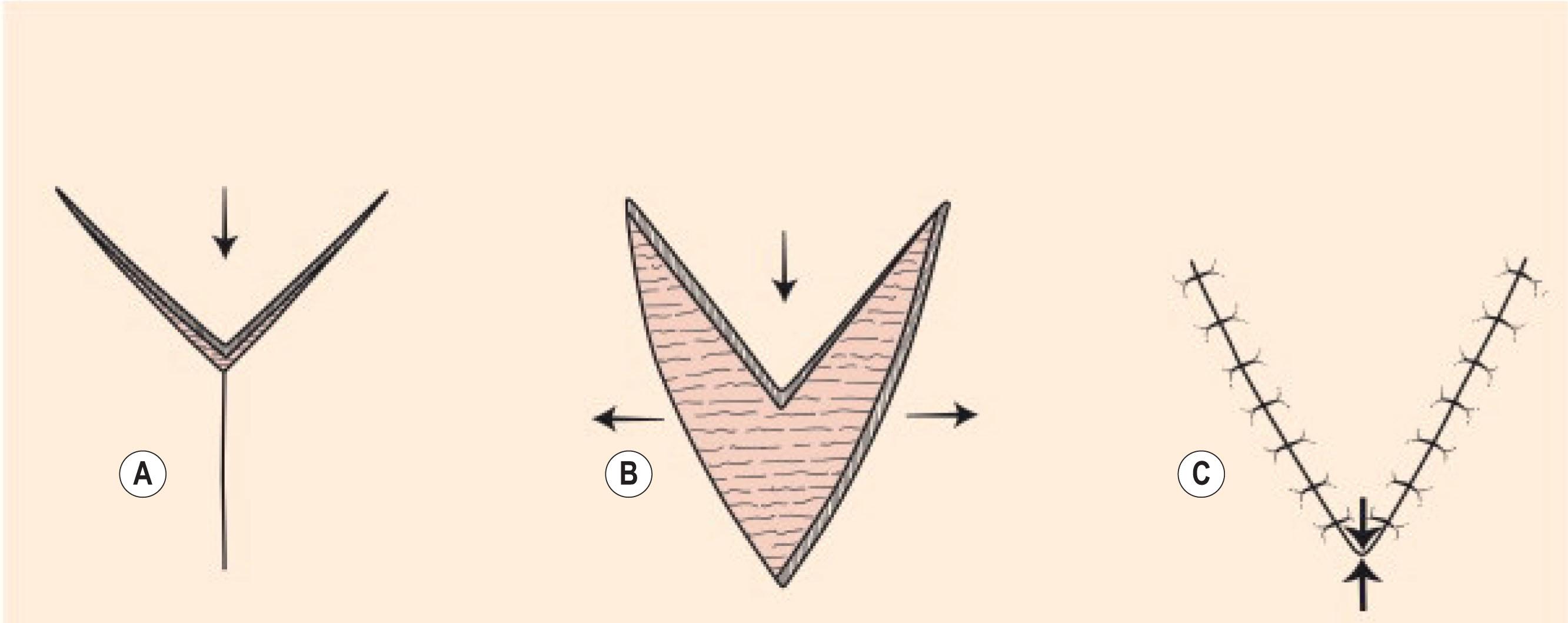 Figure 10.11, Y–V flap. (A,B) The V shaped flap is advanced/pulled towards a linear incision made at the depth of the V. (C) Greatest wound tension occurs at the recipient site and the flap’s apex (opposing arrows).