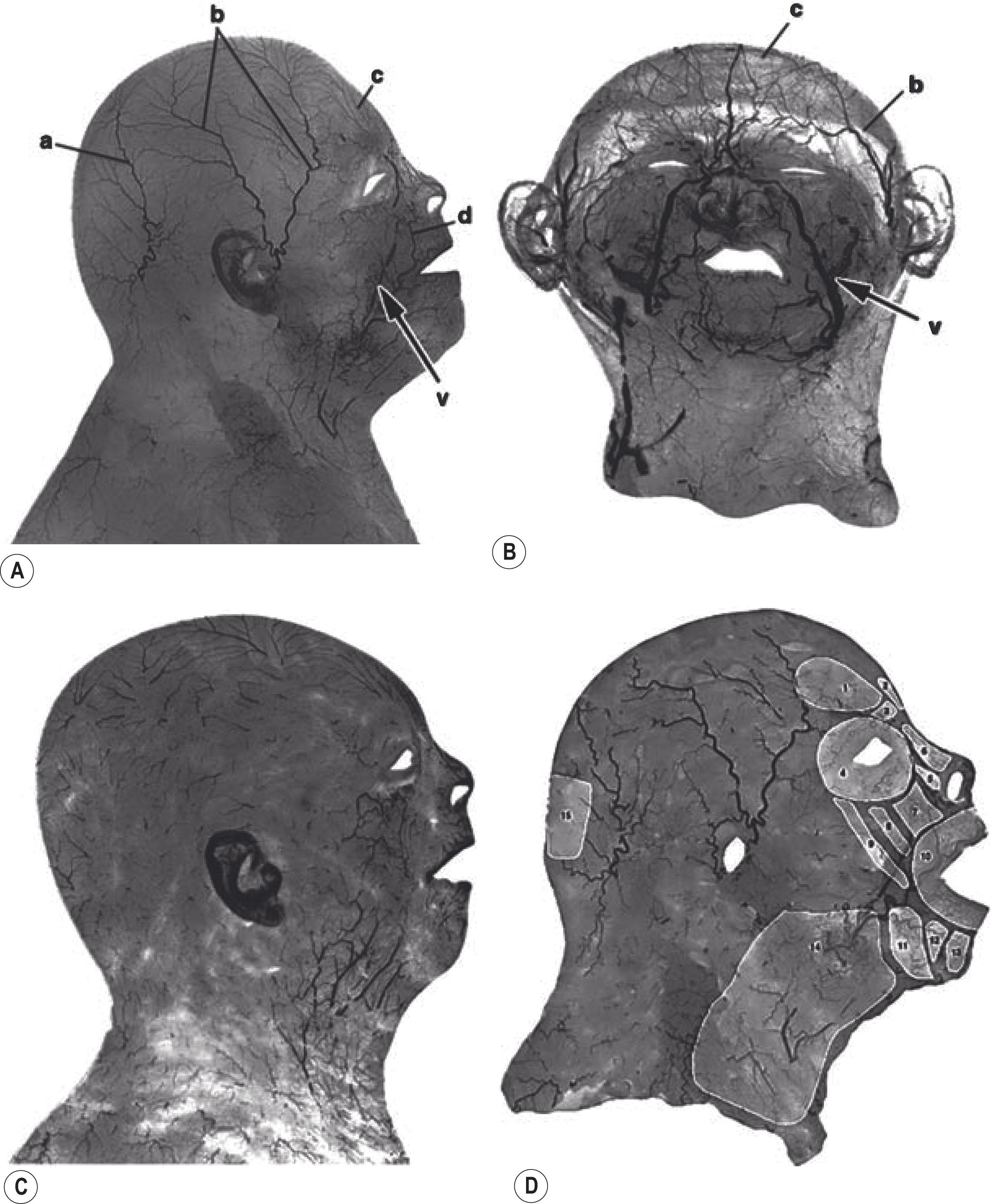 Figure 10.2, ( A–D ) Fresh cadaver lead oxide arterial study of the lateral (A) and anterior (B) view of the composite skin and SMAS unit in the head and neck. The occipital (a), superficial temporal (b), and ophthalmic (c) arteries have been labeled. The facial vein (v) runs a course at some distance from its facial artery counterpart (d). The skin layer alone (C) reveals a vast arterial “blush” area in the mobile cheek and anterior neck. This abundant blood supply makes possible large cervicofacial flaps as well as the myriad other smaller flaps from the cheek and neck possible. The SMAS layer only (D) is seen with the mimetic musculature outlined.