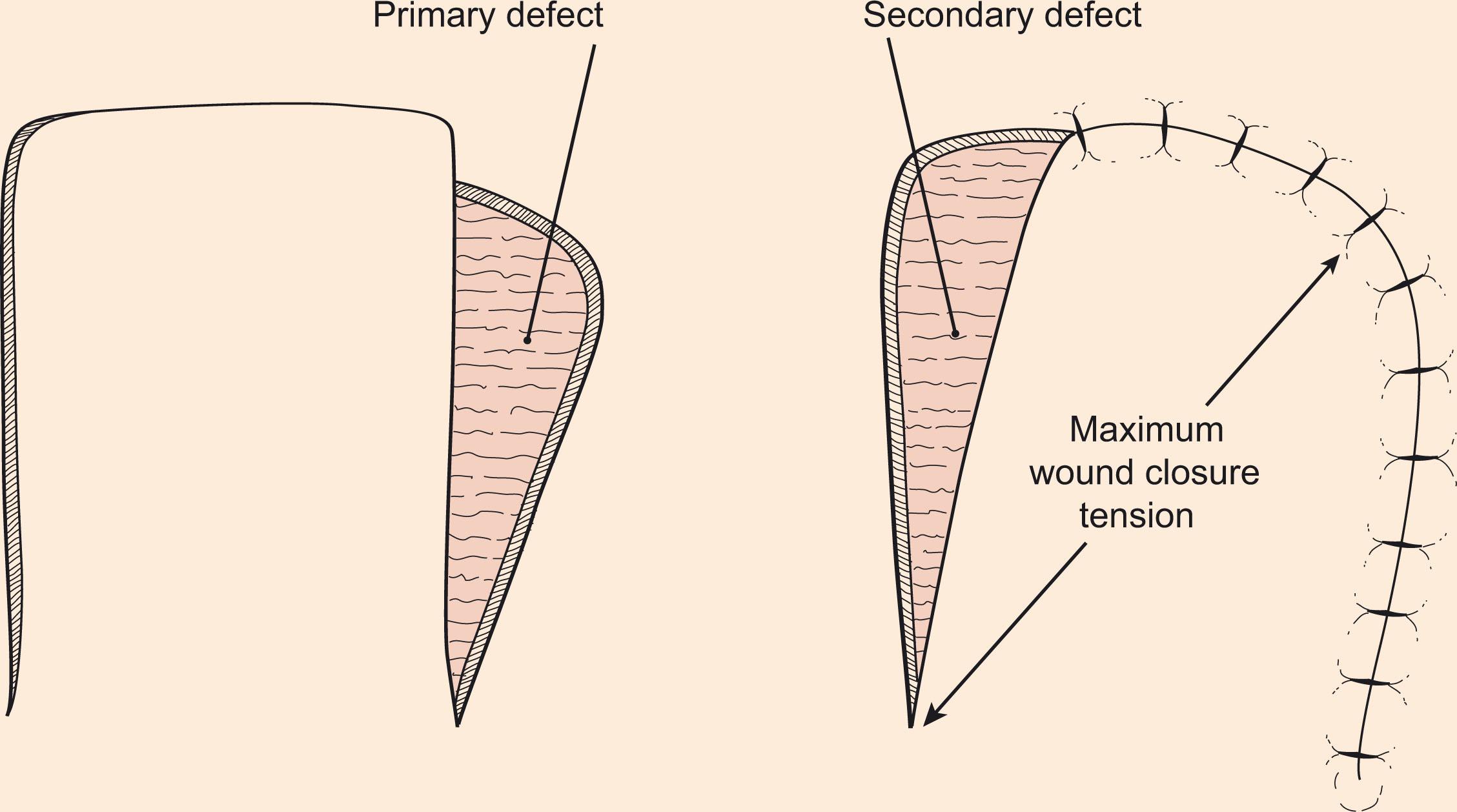 Figure 10.3, Primary vs. secondary defect. The movement of the cutaneous flap used to repair the primary defect (recipient site) results in a secondary defect (donor site).