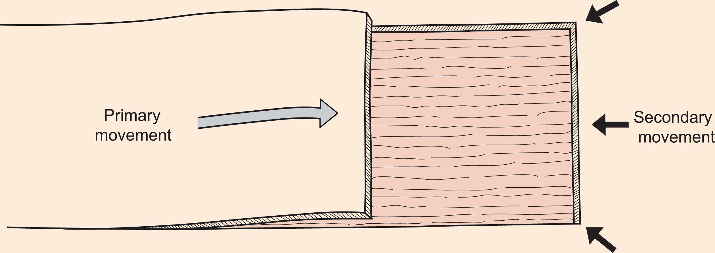 Figure 10.4, Primary vs. secondary movement. A combination of primary movement (flap advancement or pivoting) and secondary movement (recipient site advancement) occurs when a local flap is used for wound repair.