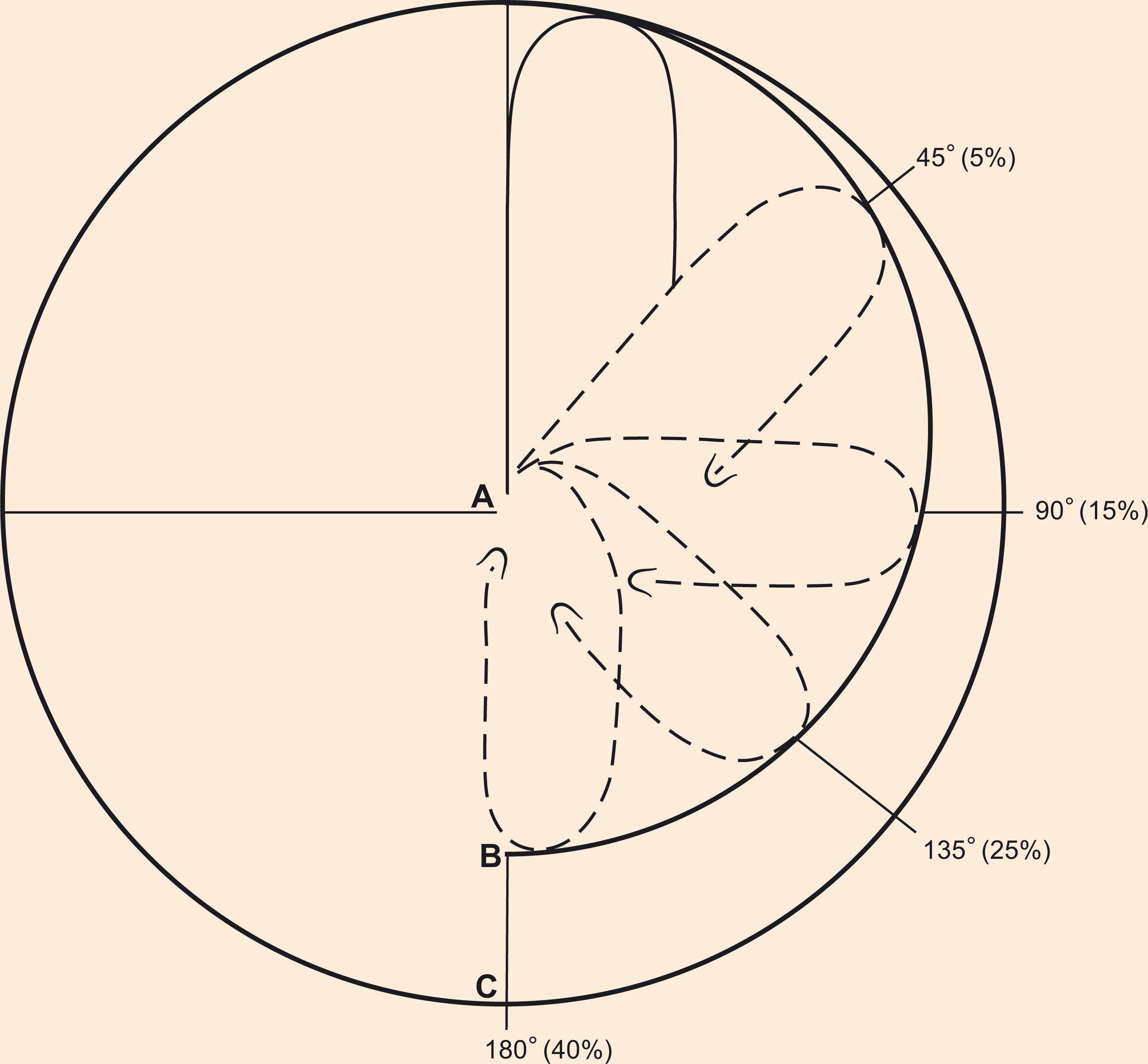 Figure 10.5, Reduction of effective length in pivotal flaps. As a transposition flap pivots, the flap bunches around its pedicle base resulting in a standing cone deformity (A) which then reduces its effective length (B) rather than (C). Estimated percentage of flap length reduction (in parentheses) is a function of the degrees of pivot.