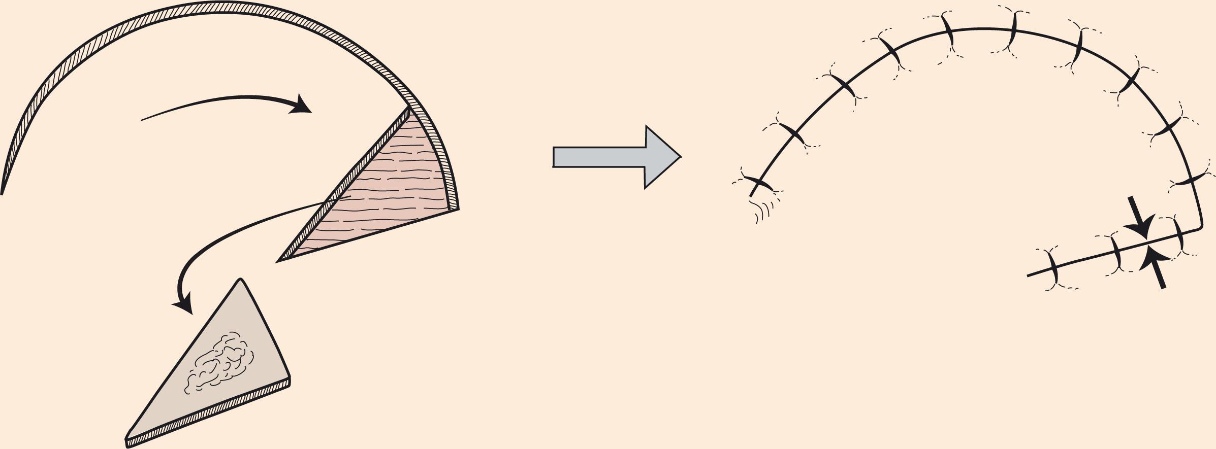 Figure 10.6, Rotation flap. Rotation flaps are pivotal flaps with a curvilinear configuration. They are designed immediately adjacent to a triangular defect. Greatest wound tension occurs at the recipient site closure (opposing arrows).