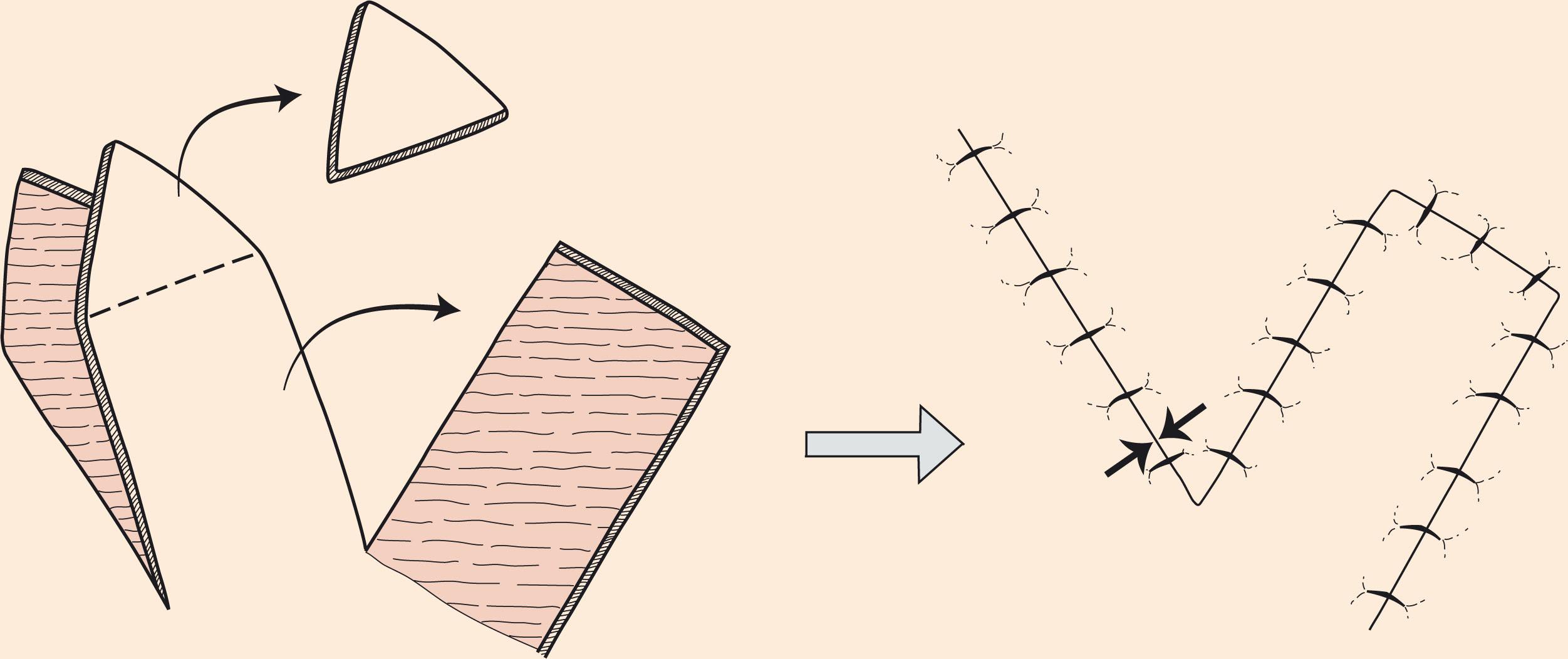 Figure 10.7, Transposition flap. Transposition flaps are pivotal flaps with a linear axis. The base of the flap is contiguous with the defect. Greatest wound tension occurs at the donor site closure (opposing arrows).