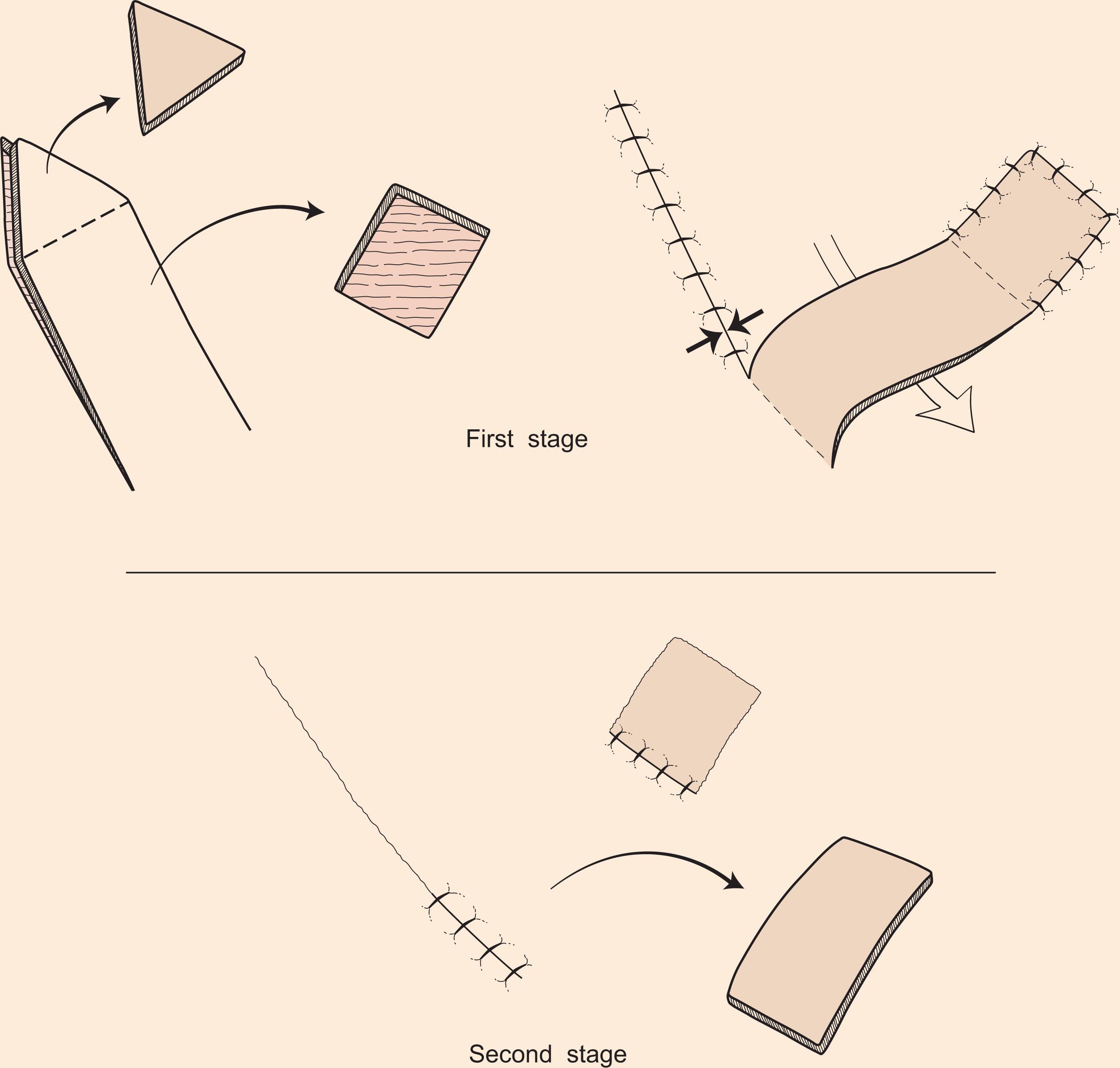 Figure 10.8, Interpolated flap. The pedicle base of an interpolated flap is not contiguous with the defect and the pedicle travels over or under intervening tissue. The pedicle, if traveling over tissue, is then divided at a second or third stage. Greatest wound tension occurs at the donor site closure (opposing arrows).