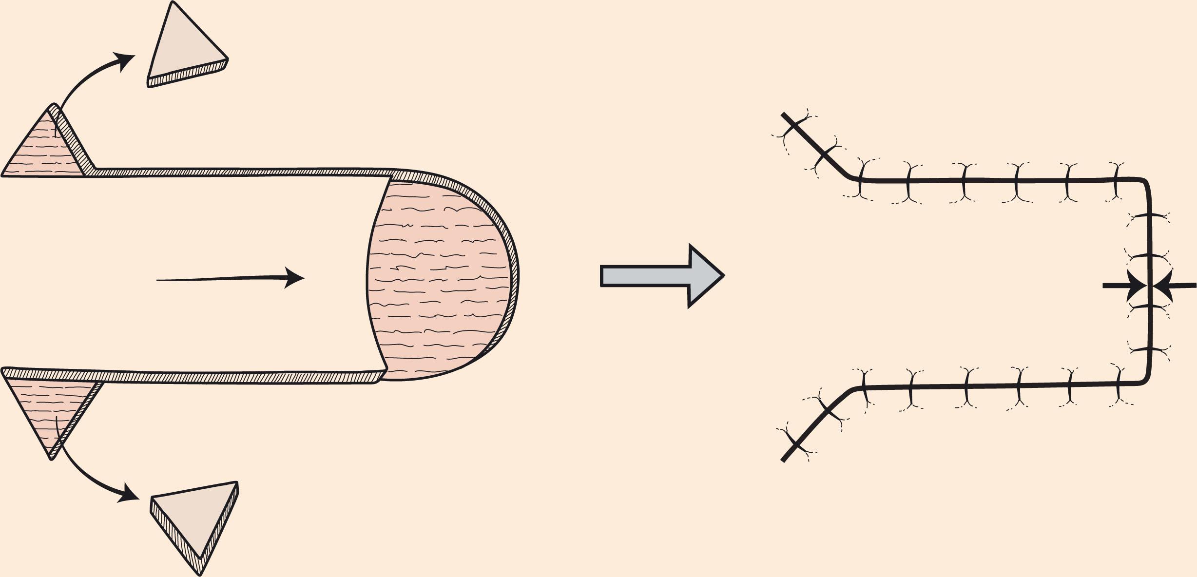 Figure 10.9, Advancement flap. Advancement flaps have a linear configuration and move by sliding into the recipient site. Greatest wound tension occurs at the recipient site closure perpendicular to the flap’s distal border (opposing arrows). By removing Burow’s triangles at the pedicle base of the flap, wound border length is equalized to the length of the primary plus secondary defect and flap advancement thus facilitated.