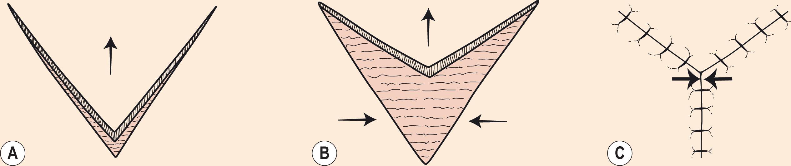Figure 10.10, V–Y flap. (A) The V-shaped flap is not stretched or pulled toward the defect. (B) Advancement is achieved instead by recoil or being pushed forward. (C) Wound closure suture line results in a Y configuration. Greatest wound tension occurs at the donor site (opposing arrows).