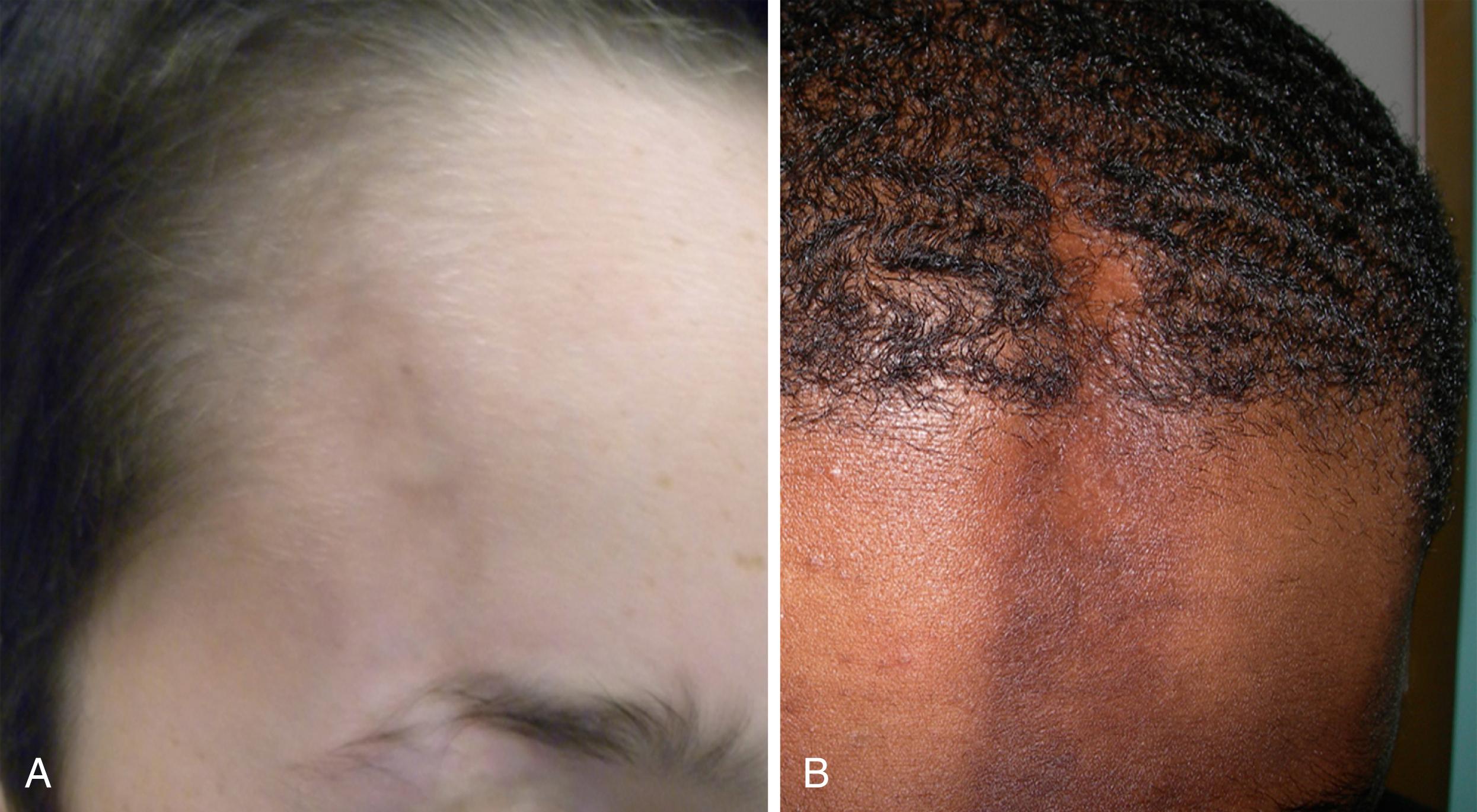 Fig. 28.3, En coup de sabre variant of morphea. A, Linear band across the forehead, with a waxy infiltration toward the eyelid causing dermal and subcutaneous atrophy, eyebrow, and eyelash losses. B, Linear band across the forehead with extension onto the scalp with hyperpigmentation, dermal and subcutaneous atrophy, and scarring alopecia.