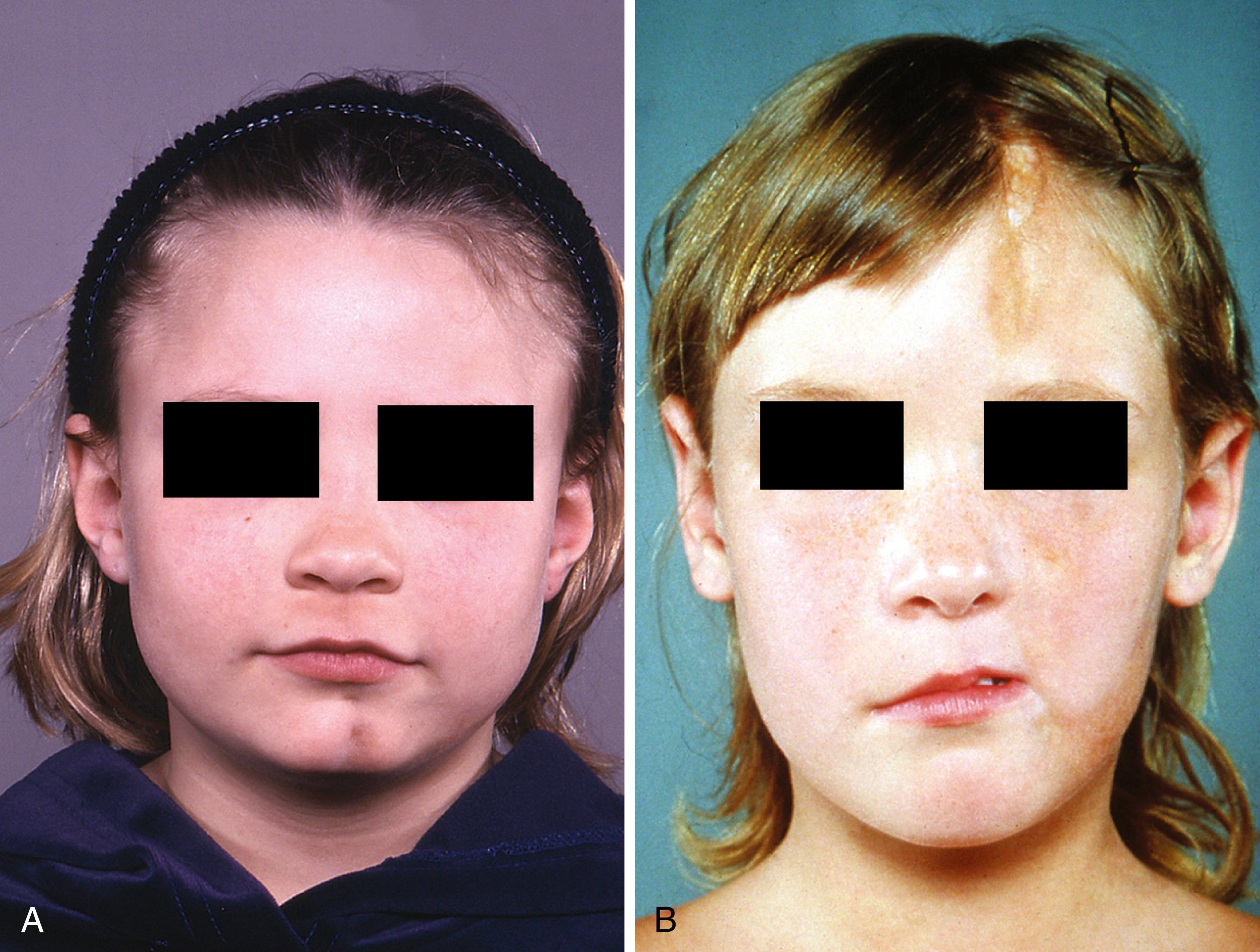 Fig. 28.4, Parry–Romberg syndrome. A, En coup de sabre linear scleroderma of approximately two years’ duration affects the chin just to the left of midline resulting in a depression and mild asymmetry of the jaw. B, En coup de sabre linear scleroderma involves the left face with hyperpigmentation, atrophy of subcutaneous tissues, and early hemifacial atrophy.