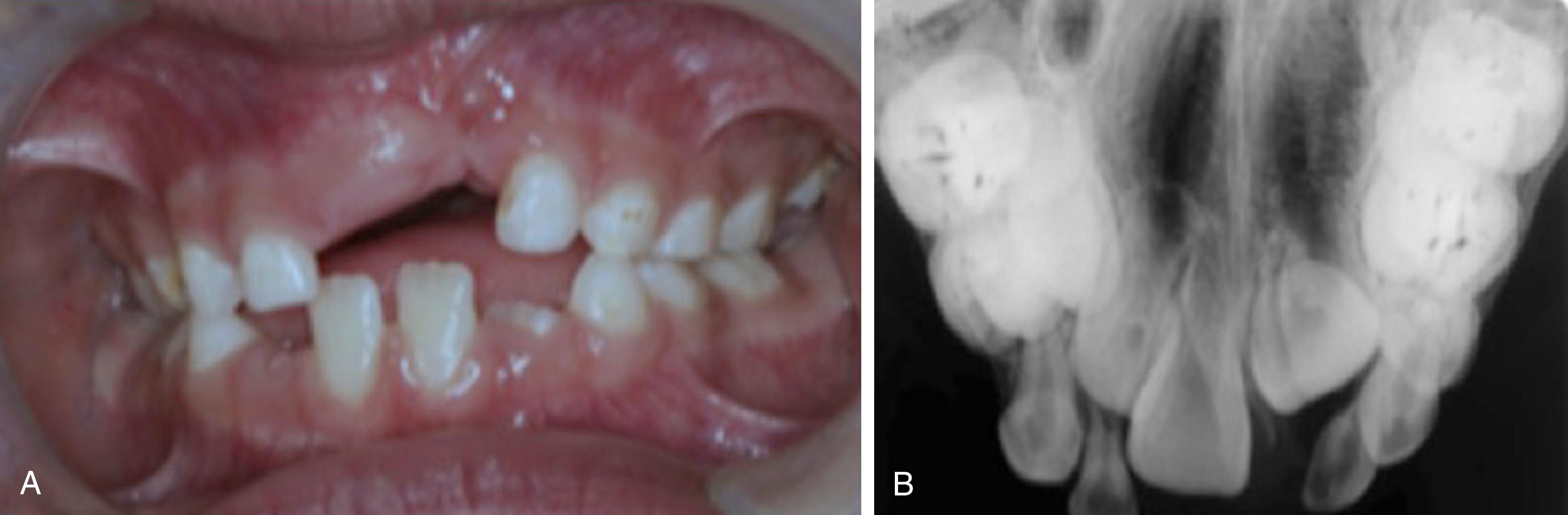 Fig. 28.5, Oral anomalies in a patient with en coup de sabre (ECDS), age 6 years 11 months. A, Patient has an asymmetrical malformation in the frontal maxillary area affecting the attached gingivae in the region of two teeth (11 and 21). B, Dental X-rays show ectopic eruption of tooth 21, which has a short malformed root development, and ectopic location of left maxillary central incisors. (From Hørberg M, Lauesen S, Daugaard-Jensen J, Kjaer I. Linear scleroderma en coup de sabre including abnormal dental development. Eur Arch Paediatr Dent 2015;16:227-31 with permission.)