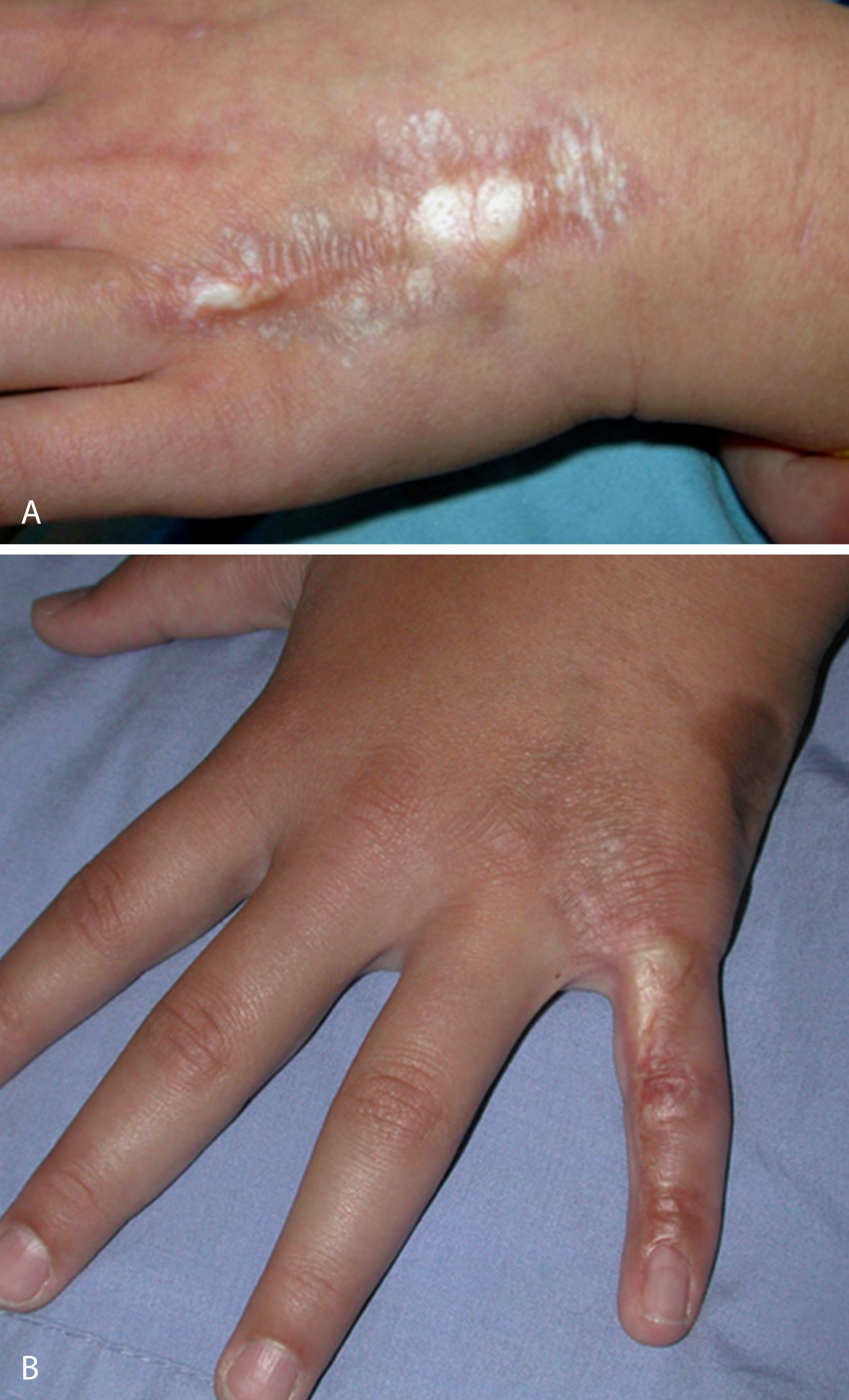 Fig. 28.6, Late-stage morphea lesions. A, Visible venous pattern resulting from epidermal and dermal atrophy. B, Hyperpigmentation and dermal loss with a “cliff border” appearance. C, Marked areas of dermal and subcutaneous atrophy.