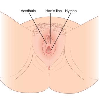 Fig. 3.1, Diagram of the vulvar vestibule.