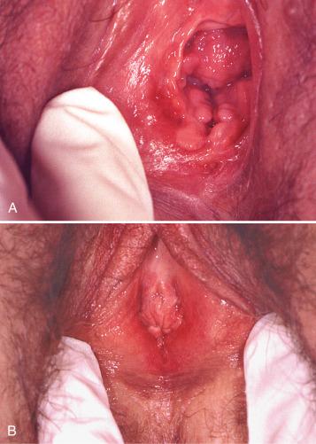 Fig. 3.2, A, B, Clinical photographs of localized vulvodynia (vestibulodynia) showing introital erythema.