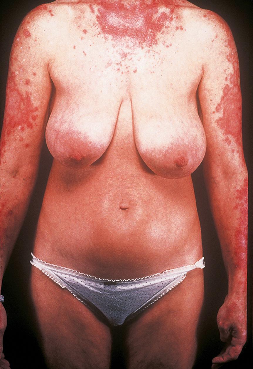 Figure 15.16, Extensive rash in sun-exposed areas in a woman with systemic lupus erythematosus and anti-Ro antibodies.