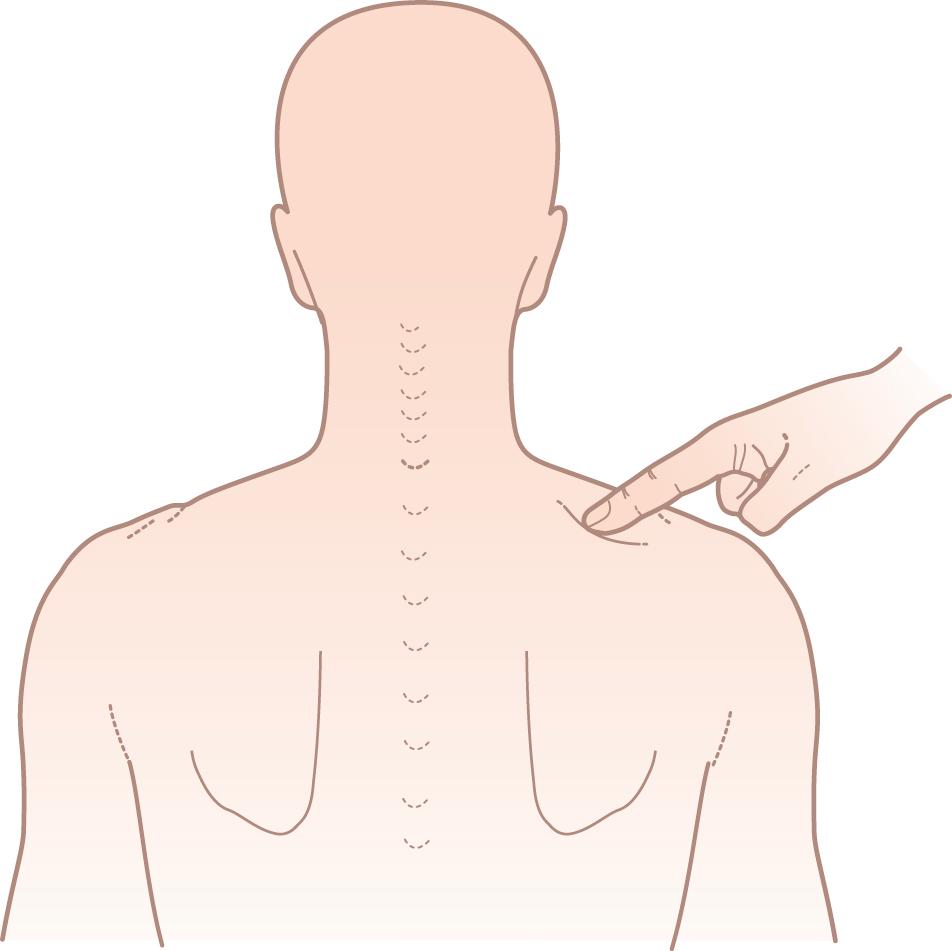 Figure 15.3, Gently press the mid-point of each supraspinatus to elicit the hyperalgesia of fibromyalgia.