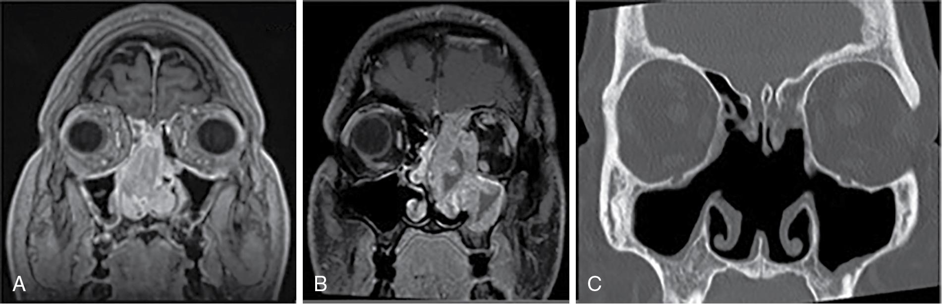 Fig. 30.1, Sinonasal malignancy or previous surgery may preclude the use of the nasoseptal flap in reconstruction. ( A ) and ( B ) are representative of an esthesioneuroblatoma and squamous cell carcinoma, respectively. ( C ) shows evidence of prior surgery, which included a large septectomy. In these instances, the septal flap is unavailable and secondary vascularized flaps should be taken into consideration.