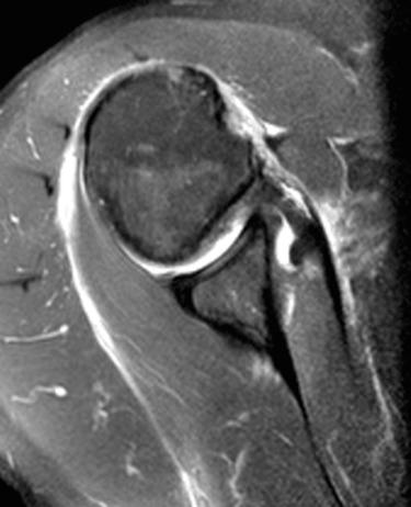 FIG. 49.1, In this axial proton density fat-suppressed magnetic resonance image of the right shoulder the subscapularis can be seen to be torn with the biceps tendon dislocated medially. In the setting of Subscapularis tears (even partial tears), one should closely evaluate for subluxation or dislocation of the long head of the biceps tendon.