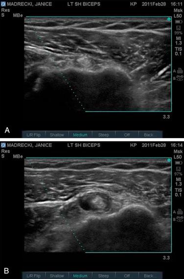 FIG. 49.2, These ultrasonographic images in the transverse plane with the dot in the upper right placed laterally demonstrate an ultrasound-guided injection of the bicipital sheath. (A) Preinjection. (B) Postinjection, engorgement of the bicipital sheath with steroid can be seen.