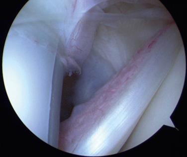 FIG. 49.3, This arthroscopic image of the right shoulder in the beach chair position viewed from the posterior portal shows a probe entering from the anterior portal and retracting the biceps intraarticularly. Extensive inflammation and synovitis can be seen on the anterior aspect of the bicipital tendon.