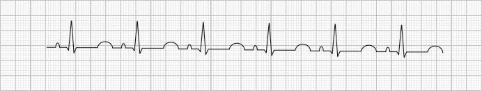 Fig. 155.1, ECG rhythm strip demonstrating prolonged QTc.