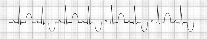 Fig. 155.2, T-wave alternans is the beat-to-beat variability of the polarity (seen here) or morphology of the T wave.