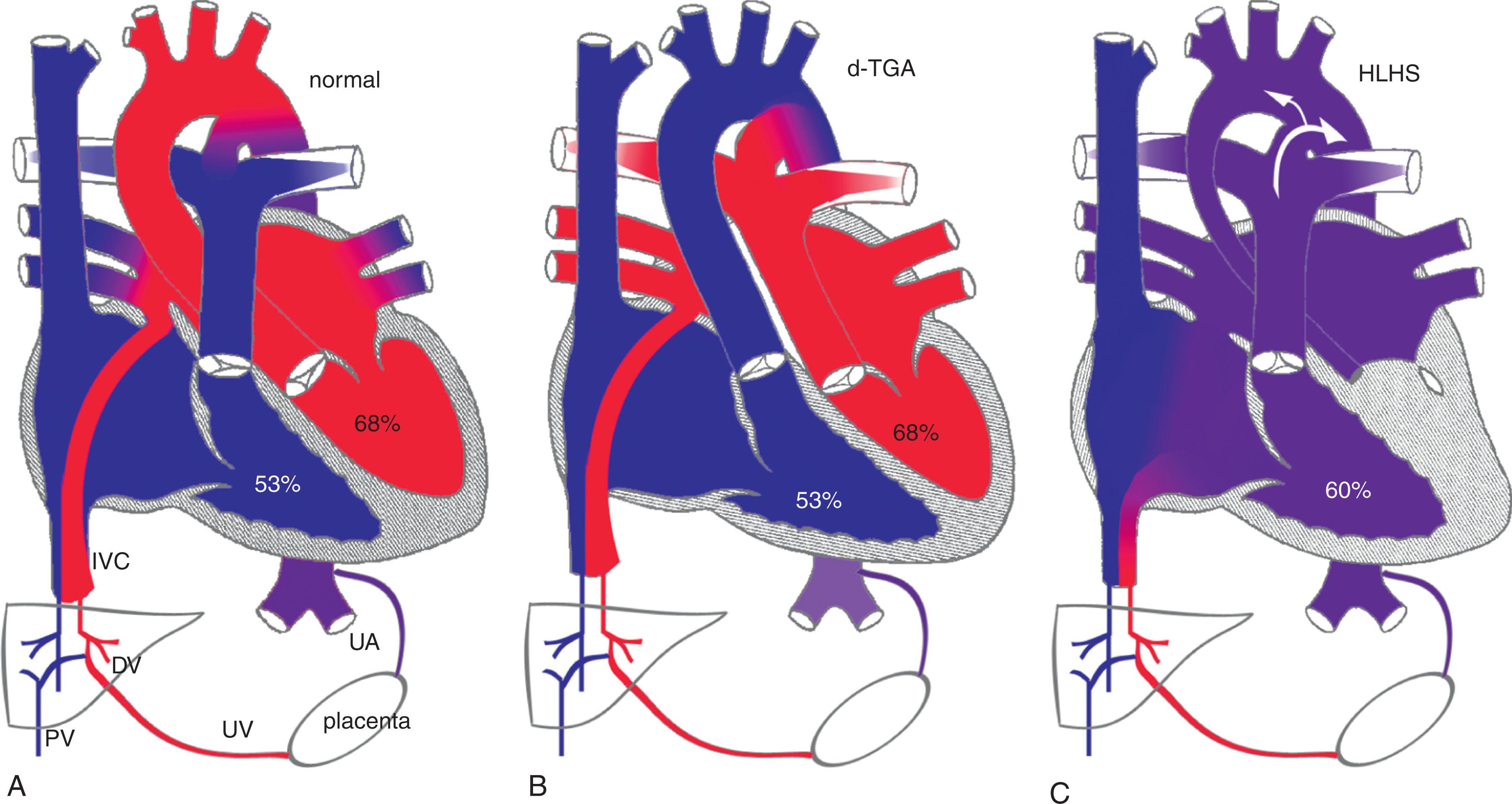 Fig. 51.1, Normal and Altered Fetal Circulation.