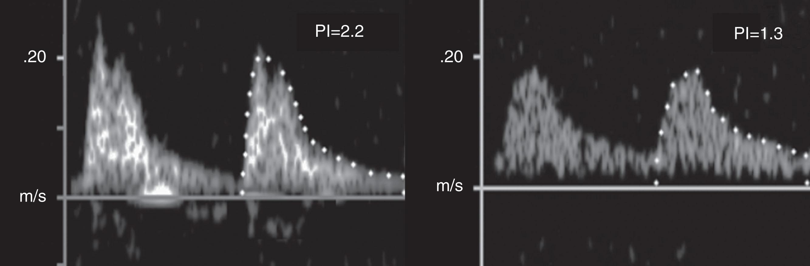 Fig. 51.2, Middle cerebral artery Doppler patterns in a normal fetus and a fetus with hypoplastic left heart syndrome (HLHS). The pulsatility index (peak systolic velocity–end diastolic velocity/mean velocity) in the HLHS fetus is lower (right panel) , suggesting decreased impedance in the cerebral vasculature. PI , Pulsatility index.