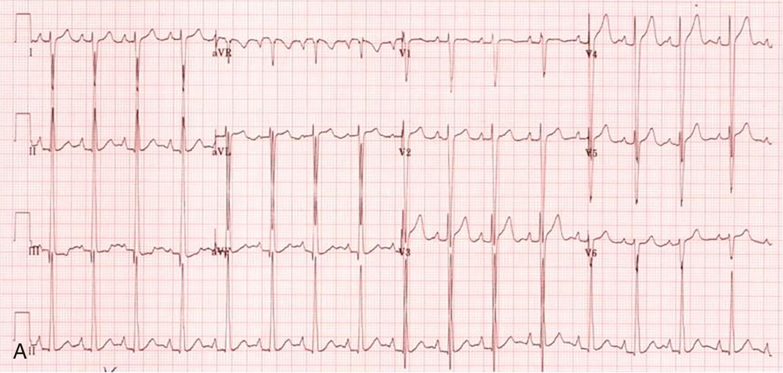 Fig. 73.11, (A) ECG demonstrating preoperative sinus rhythm in a 7-year-old female with congenitally corrected transposition of the great arteries and hypoplastic left ventricle who underwent an extracardiac conduit Fontan with tricuspid valvuloplasty. (B) Postoperative ECG of the same patient demonstrating high-grade AV block with junctional escape beats. Note intermittently conducted P waves (red arrows) .