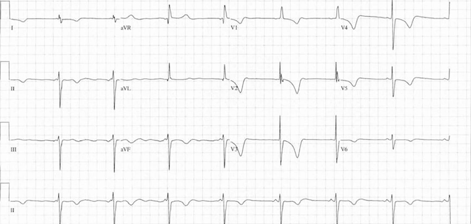 Fig. 73.12, Sinus bradycardia and junctional rhythm in an asymptomatic 33-year-old male with an atriopulmonary Fontan.