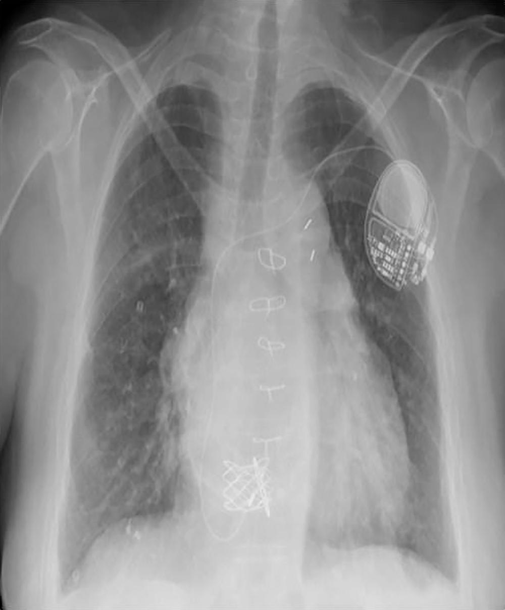 Fig. 73.13, Chest radiography of a 53-year-old female with tricuspid atresia who underwent a modified Fontan with right atrium (RA) to right ventricle (RV) valved conduit and required transvenous atrial pacing. Note the low position of the atrial lead. It is not unusual to have to place leads in uncommon positions in the Fontan population since areas of viable myocardial tissue can be limited. A Melody valve has been placed in the RA to RV conduit.