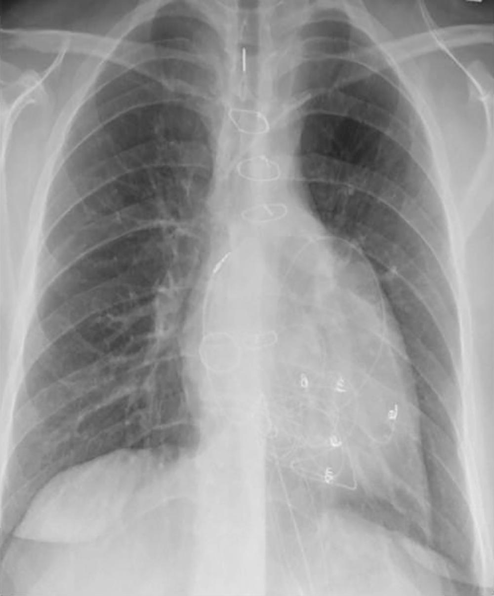 Fig. 73.14, Chest radiography of the patient in Fig. 73.13 after placement of an epicardial pacemaker system with one atrial and five unipolar ventricular leads, one of which is disconnected. Two sets of unipolar leads were placed to resynchronize the functional single ventricle because of ventricular dysfunction. The atrial lead is an endocardial lead placed epicardially.