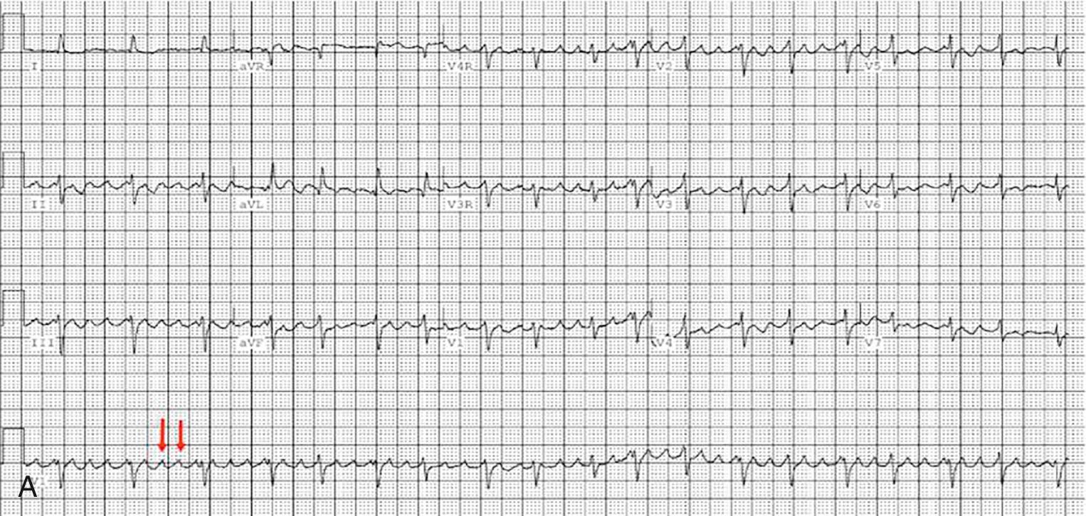 Fig. 73.15, (A) ECG demonstrating intraatrial reentrant tachycardia in a 53-year-old female with tricuspid atresia who underwent a modified Fontan with right atrium to right ventricle valved conduit. The red arrows mark P waves. (B) Intracardiac electrograms of the same patient demonstrating a second inducible intraatrial reentrant tachycardia following successful ablation of the tachycardia seen in Fig. 73.11A . There was an area of slow conduction in the superior right atrium with low amplitude, fractionated signals best depicted in the T2 position of a multielectrode catheter (red arrows) . Successful ablation was performed at this site. Note also the diffuse low voltage/absent signals at other electrodes on this scarred atrium.