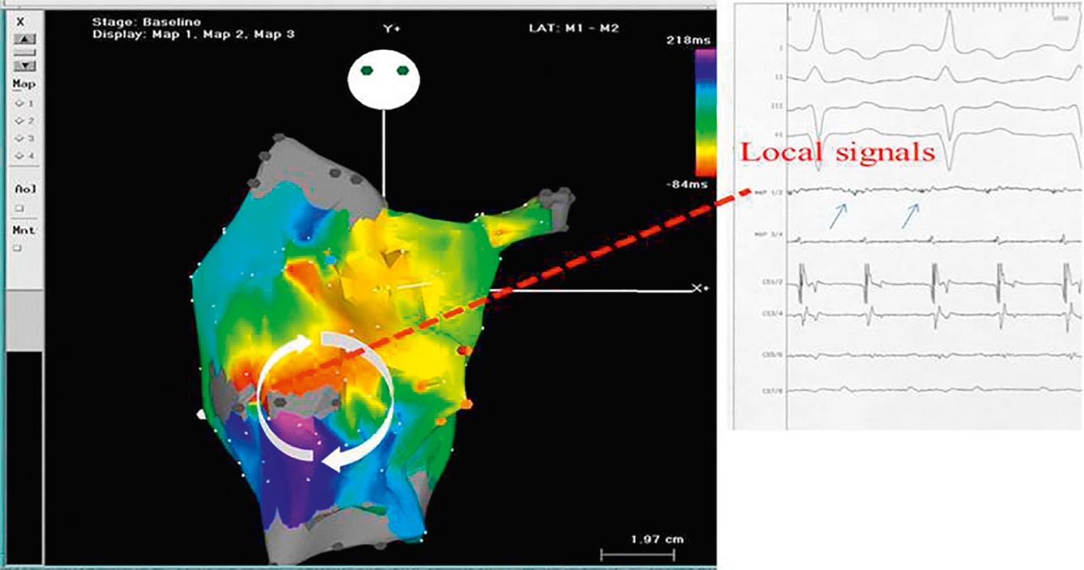 Fig. 73.16, An anteroposterior projection of a three-dimensional electroanatomic map in a patient with intraatrial reentrant tachycardia (IART) post Fontan. The white arrows show the IART circuit, with the critical zone located in a gap in a scar (gray areas) on the lateral wall. The intracardiac signals taken at this zone (blue arrows) show long, low-voltage, fractionated signals. A single radiofrequency lesion in that area interrupted the tachycardia.