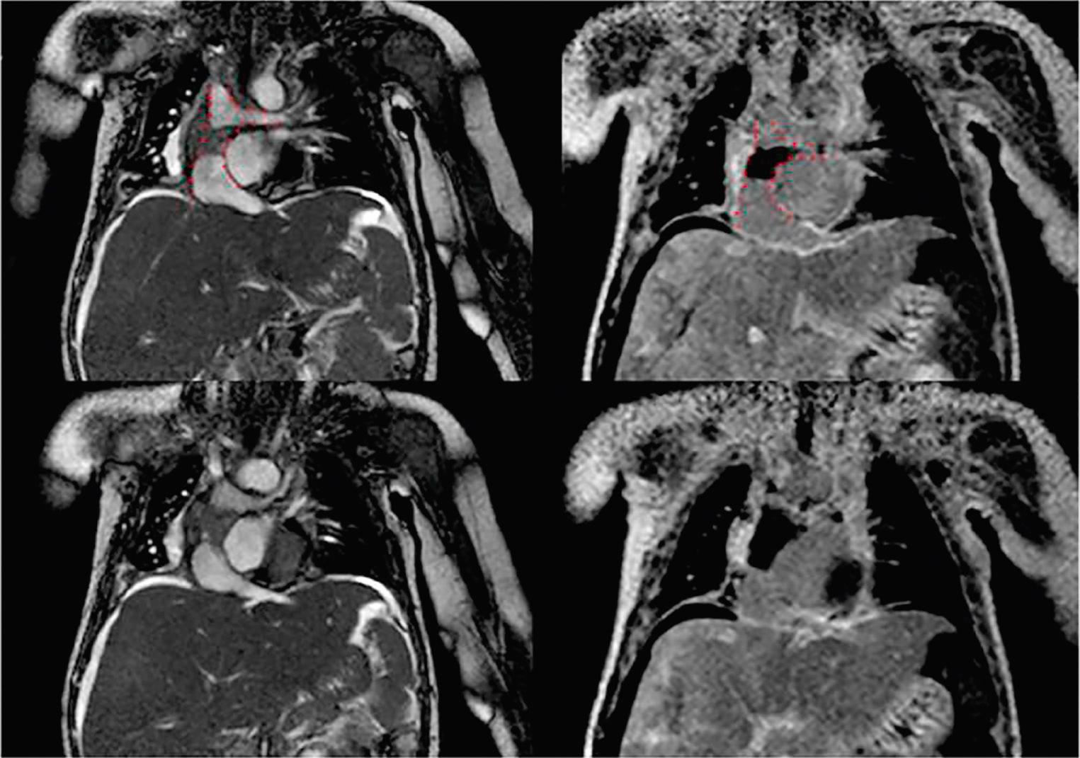 Fig. 73.18, Coronal plane magnetic resonance imaging in a patient with a large thrombus within the extracardiac Fontan pathway. The red dots show the location of the thrombus.