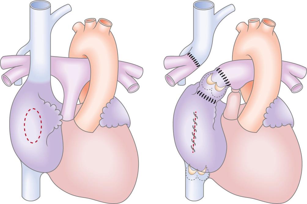 Fig. 73.2, First version of the corrective procedure for the treatment of tricuspid atresia, as published by Fontan and Baudet. The right pulmonary artery has been anastomosed to the superior vena cava, and the left pulmonary artery to the right atrial appendage. Valves were placed between the inferior vena cava and the right atrium and between the right atrium and the left pulmonary artery.