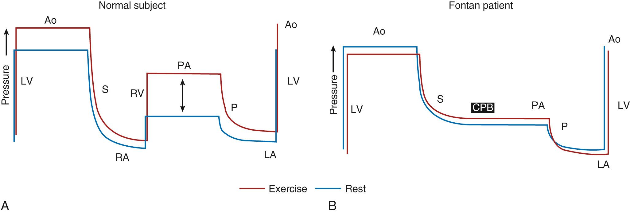 Fig. 73.7, Theoretical schema to illustrate circulatory pressure changes in normal and Fontan patients at rest (blue) and during exercise (red) . In the normal circulation (A), pressure is generated in the systemic ventricle (LV) to produce flow in the aorta (Ao) and systemic circulation (S). Pressure dissipates across the systemic microcirculation such that right atrial (RA) pressure is low. The prepulmonary pump (RV) provides the pressure to generate the flow in the pulmonary artery (PA) , which then dissipates in the pulmonary circulation (P) but is sufficient to maintain preload in the left atrium (LA). During exercise, systemic vascular resistance falls such that there is little increase in mean LV pressure requirements. However, more substantial pressure increases are required in the RV, and these pressure requirements increase with exercise intensity. In the Fontan patient (B), the cavopulmonary bypass (CPB) does not provide any contractile force, and therefore flow through the pulmonary circulation is dependent on the pressure difference between the RA and LA. During exercise, transpulmonary flow can be augmented only by a reduction in pulmonary vascular resistance. Beyond mild to moderate exercise, pulmonary vasodilation is maximal and flow increases require a prepulmonary pump. Without this, pulmonary pressure does not rise, transpulmonary flow does not increase, LA pressure (preload) does not increase, and cardiac output cannot supply the metabolic demands of exercise.