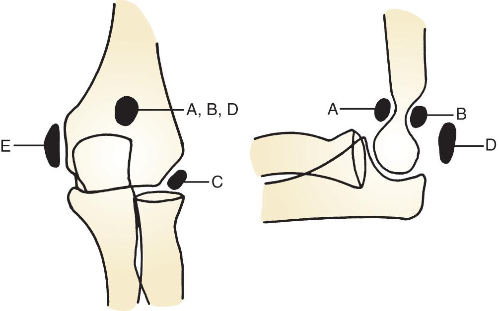 FIG 84.1, Identification of accessory ossicles.