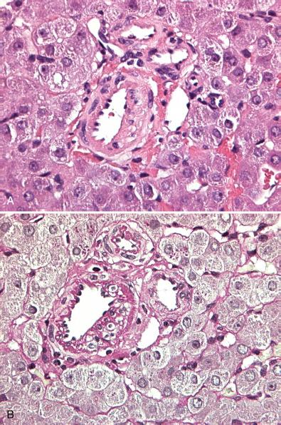 Figure 28.3, Needle biopsy of a hepatic adenoma showing a portal tract-like structure containing several profiles of thick-walled arterioles but no bile duct or bile ductules, thus mimicking a portal tract with loss of intrahepatic bile ducts. ( A , Hematoxylin and eosin; B , periodic acid–Schiff stain after diastase digestion.)
