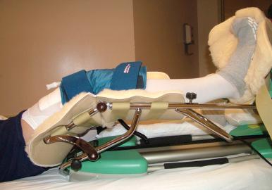 Fig. 108.11, A continuous passive motion machine is used in the early postoperative phase to help prevent a hemarthrosis by keeping the knee above the level of the heart. A cold/compression device is also applied to the knee.