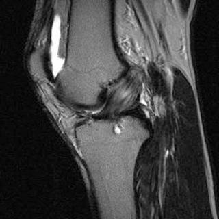 Fig. 108.5, A magnetic resonance image showing mucoid degeneration of the anterior cruciate ligament.