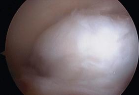 Fig. 108.6, An arthroscopic view of a cyclops lesion on the anterior aspect of the anterior cruciate ligament graft.