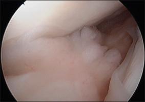 Fig. 108.8, An arthroscopic view of anterior scar tissue extending into the medial compartment.