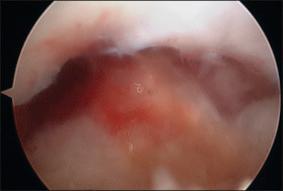 Fig. 108.10, An arthroscopic view after débridement of scar tissue (in the same knee as depicted in Figs. 108.7 and 108.8 ) shows a good fit of the anterior cruciate ligament graft in the intercondylar notch.