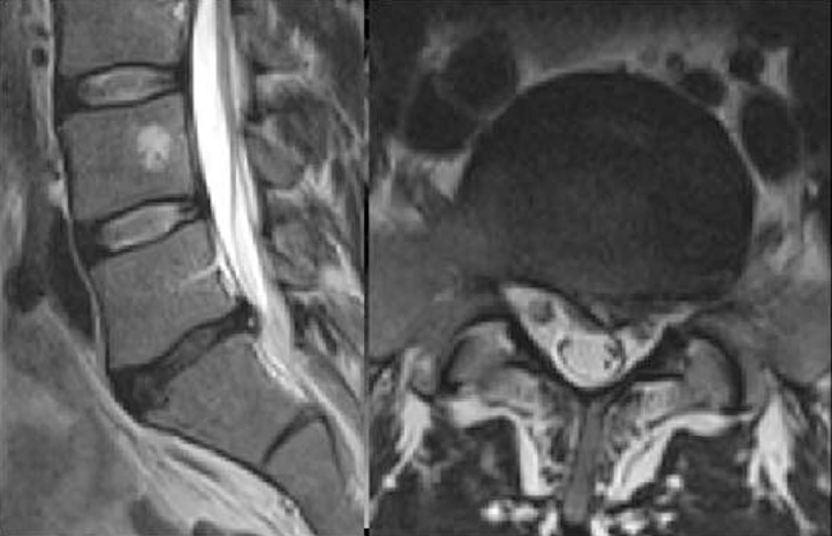 Figure 29.3 T2-weighted sagittal and axial magnetic resonance images of disk protrusion.