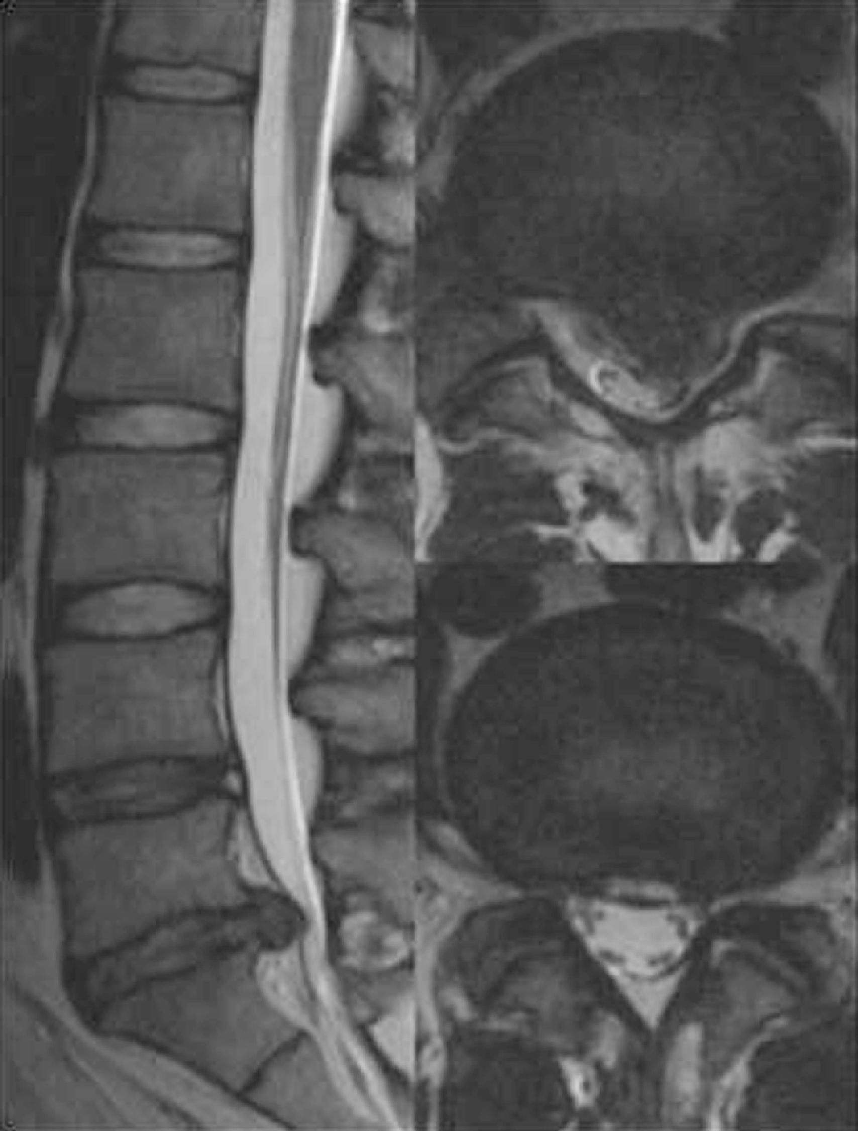 Figure 29.4 T2-weighted sagittal magnetic resonance images of a 31-year-old man with severe axial and lower extremity pain showing two distinct disk pathologies. At the L5-S1 level, there is left-sided disk extrusion, and the L4-5 disk shows desiccation and a high-intensity zone; the remaining disks appear normal.