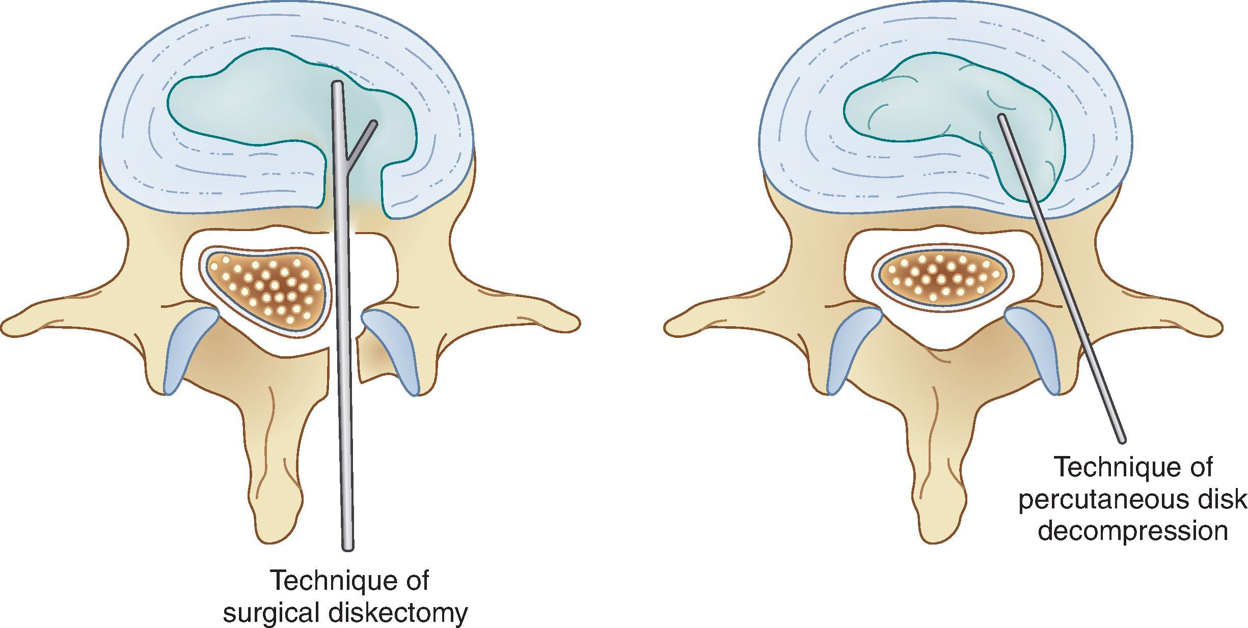 Figure 29.5 Schematic depiction of surgical discectomy and percutaneous disk decompression.