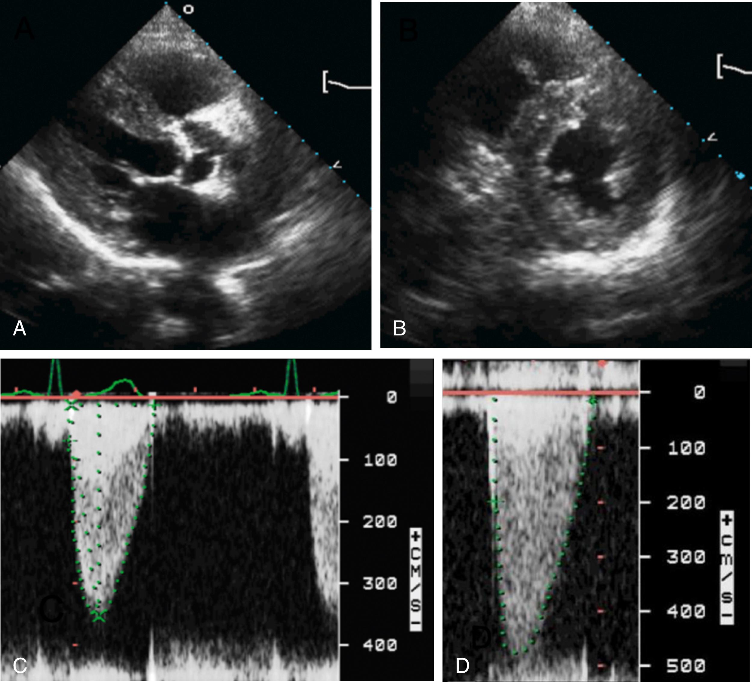 Figure 83.2, Patient with paradoxical low-flow, low-gradient aortic stenosis (AS). This is the case of a 78-year-old woman with a history of calcific AS who is in New York Hear Association functional class III. The parasternal long- and short-axis views show a small left ventricular cavity with pronounced concentric remodeling and preserved left ventricular ejection fraction (LVEF) and a calcified and thickened aortic valve with restricted opening ( A and B ; see Video 83.2A , Video 83.2B , Video 83.2C ). This patient underwent low-dose dobutamine stress echocardiography up to 15 μg/kg/min. The LVEF increased from 60% to 70%, the stroke volume increased from 42 to 52 mL, the peak/mean gradient increased from 51/29 to 94/57 mm Hg ( C and D ), and the aortic valve area increased slightly from 0.70 to 0.77 cm 2 . This is a case of paradoxical low-flow, low-gradient severe AS. This patient underwent a successful aortic valve replacement.