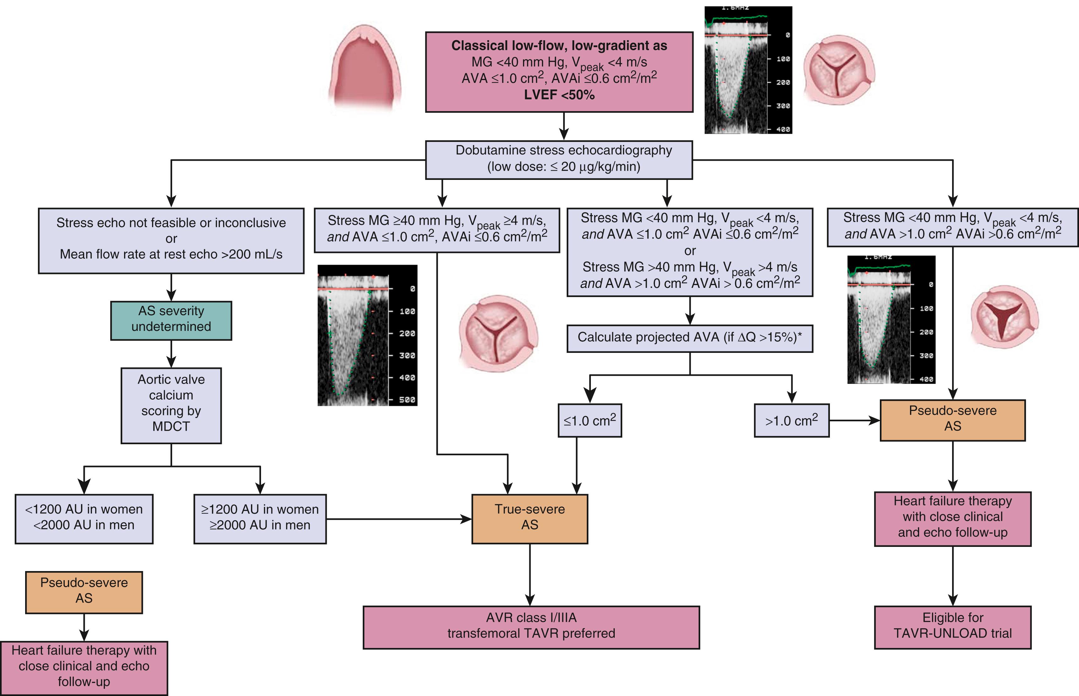 Figure 82.1, Algorithm for the diagnostic and therapeutic management of patients with low-flow, low-gradient aortic stenosis and reduced left ventricular ejection fraction (LVEF). AU, Arbitrary unit using the Agatston calcium scoring method; AVA, aortic valve area; AVR, aortic valve replacement; MG, mean transvalvular gradient; projected AVA, projected aortic valve area at normal flow rate (250 mL/s); MDCT, multidetector computed tomography; TAVR, transcatheter aortic valve replacement; TAVR-UNLOAD trial, Transcatheter Aortic Valve Replacement to UNload the Left Ventricle in Patients With ADvanced Heart Failure randomized trial; ΔQ, relative increase in mean flow rate (stroke volume/left ventricular ejection time); V Peak , peak transvalvular velocity.
